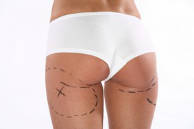 Liposuccion